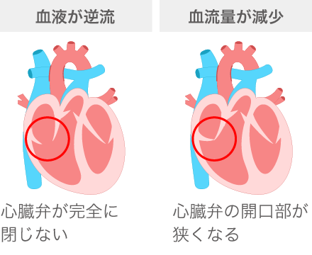 心臓弁膜症