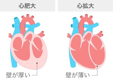 心筋症